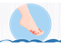 为什么得了水泡型脚气 导致水泡型脚气的原因是什么