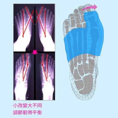 批发脚趾外翻矫正器充气式脚趾外翻矫正器脚趾分离器厂家直发图3