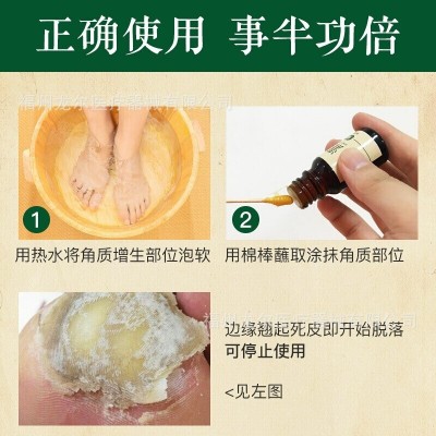 修正皮肤抑菌液清茧灵抑菌液手足老茧脖子肉粒草本护肤清茧子死皮图2