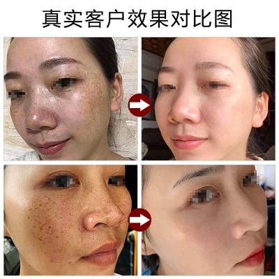 美容院美白祛斑霜美白去黑色素黄褐斑真皮斑祛斑套盒祛斑霜炸斑霜图3