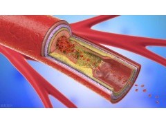红酒、洋葱、黑木耳能“软化血管”？医生提醒：别再被坑了