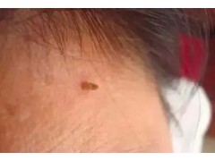 脖子上长出的小肉粒，到底是啥啊？
