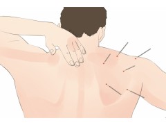 针灸的功效与作用