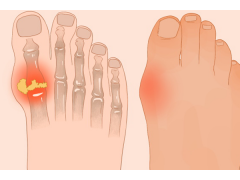 痛风能吃板栗吗