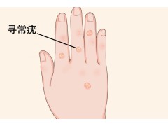 感染HPV有什么症状