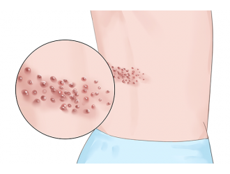 带状疱疹冬天高发吗